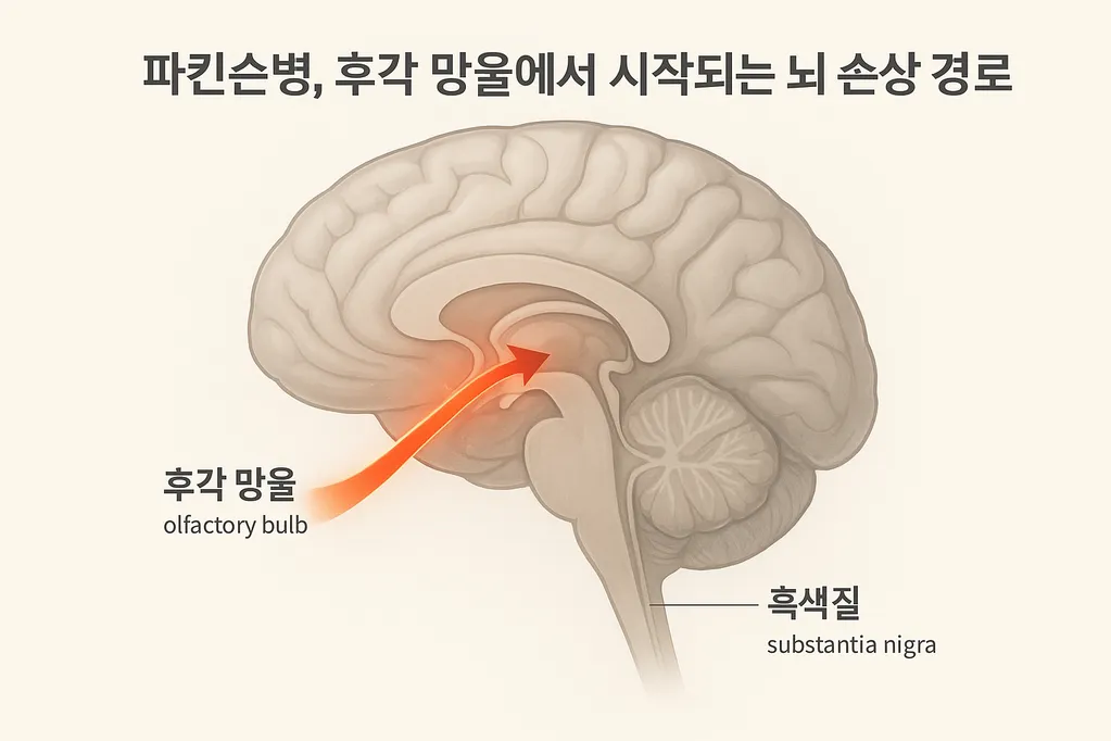 파킨슨병, 후각 망울에서 시작되는 뇌 손상 경로